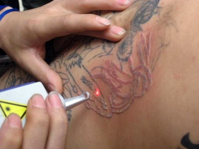 Clareamento de Tatuagem Preço em São Caetano do Sul - Remoção de Tatuagem Colorida