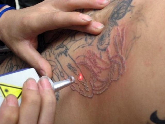 Clareamento de Tatuagem Preço em São Caetano do Sul - Especialista em Remoção de Tatuagens