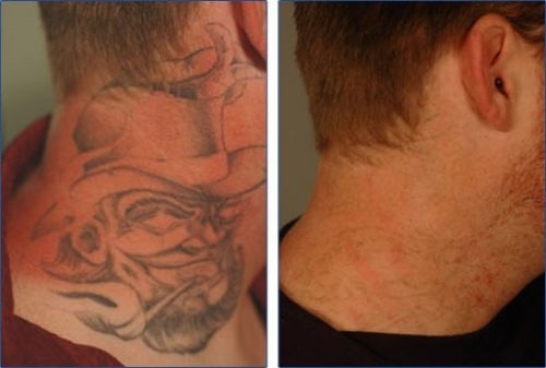 Clareamento de Tatuagem em São Caetano do Sul - Clínica de Remoção de Tatuagem