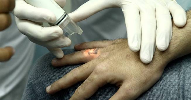 Clínica de Remoção de Tatuagem Preço em São Caetano do Sul - Especialista em Remoção de Tatuagens
