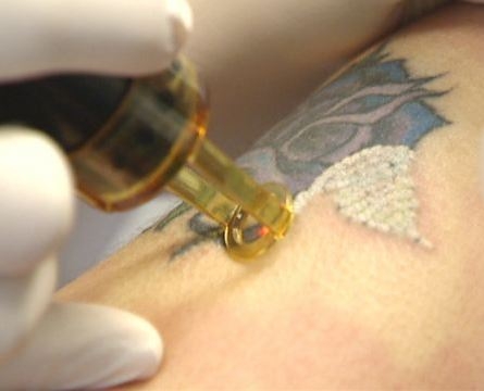 Clínica de Remoção de Tatuagens em São Caetano do Sul - Remoção de Tatuagem a Laser