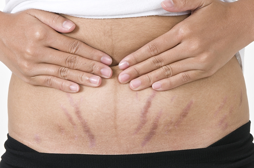 Clínicas para Tratamento Corporal para Estrias em São Caetano do Sul - Estética Corporal