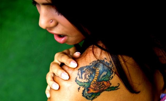 Especialista em Remoção de Tatuagens em Santo André - Remoção de Tatuagem
