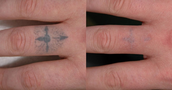 Onde Encontrar Clareamento de Tatuagem em Santo André - Remover Tatuagens