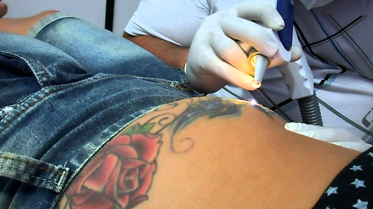 Onde Encontrar Remoção de Tatuagem Colorida em Santo André - Remoção de Tatuagem