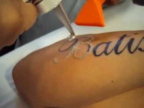 Onde Encontrar Remoção de Tatuagem em Santo André - Remoção de Tatuagens em Sp