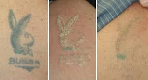 Orçamento para Clareamento de Tatuagem em São Caetano do Sul - Remoção de Tattoo