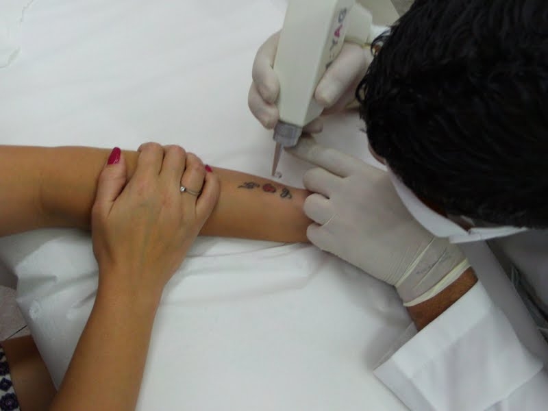 Orçamento para Clínica de Remoção de Tatuagem em São Caetano do Sul - Remoção de Tattoo