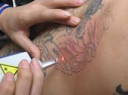 Orçamento para Remoção de Tattoo em São Caetano do Sul - Remoção de Tatuagem em São Bernardo do Campo
