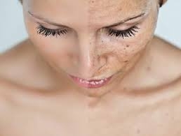 Orçamento para Tratamento Facial para Manchas em São Bernardo do Campo - Tratamento Facial para Acne