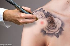 Remoção de Tattoo Preço em São Caetano do Sul - Clareamento de Tatuagem