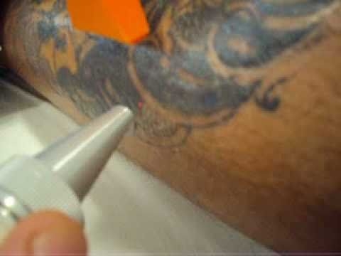 Remoção de Tattoo em São Bernardo do Campo - Remoção de Tatuagem Colorida