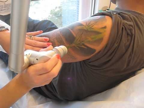 Remoção de Tatuagem Colorida em Santo André - Serviços de Remoção de Tatuagem