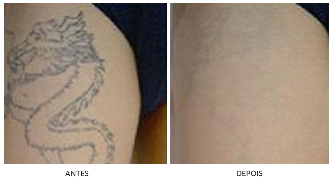 Remoção de Tatuagens em São Bernardo do Campo em São Bernardo do Campo - Remoção de Tatuagem a Laser