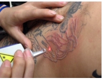 clareamento de tatuagem preço em Santo André