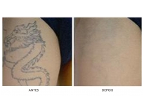clareamento de tatuagens em Santo André