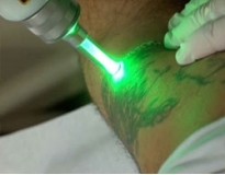 clínica de remoção de tatuagem em Santo André