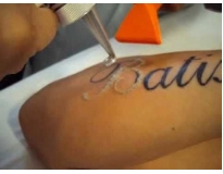 onde encontrar remoção de tattoo em São Caetano do Sul