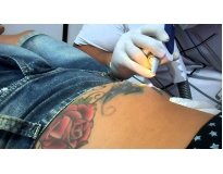onde encontrar remoção de tatuagem colorida em São Caetano do Sul
