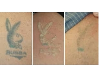 orçamento para clareamento de tatuagem em Santo André