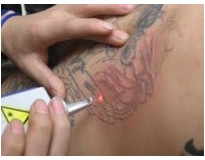 orçamento para remoção de tattoo em Santo André