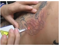 orçamento para remoção de tatuagem em Santo André