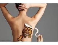 orçamento para remover tatuagens em São Caetano do Sul
