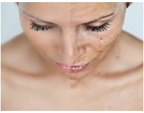 orçamento para tratamento facial para manchas em São Caetano do Sul