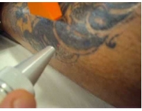 remoção de tattoo em Santo André