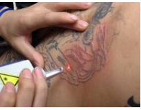 remoção de tatuagem a laser preço em Santo André