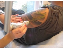 remoção de tatuagem colorida em Santo André