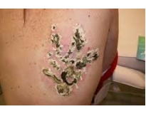 remoção de tatuagem em sp em Santo André
