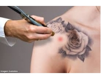 remoção de tatuagens em sp preço em Santo André
